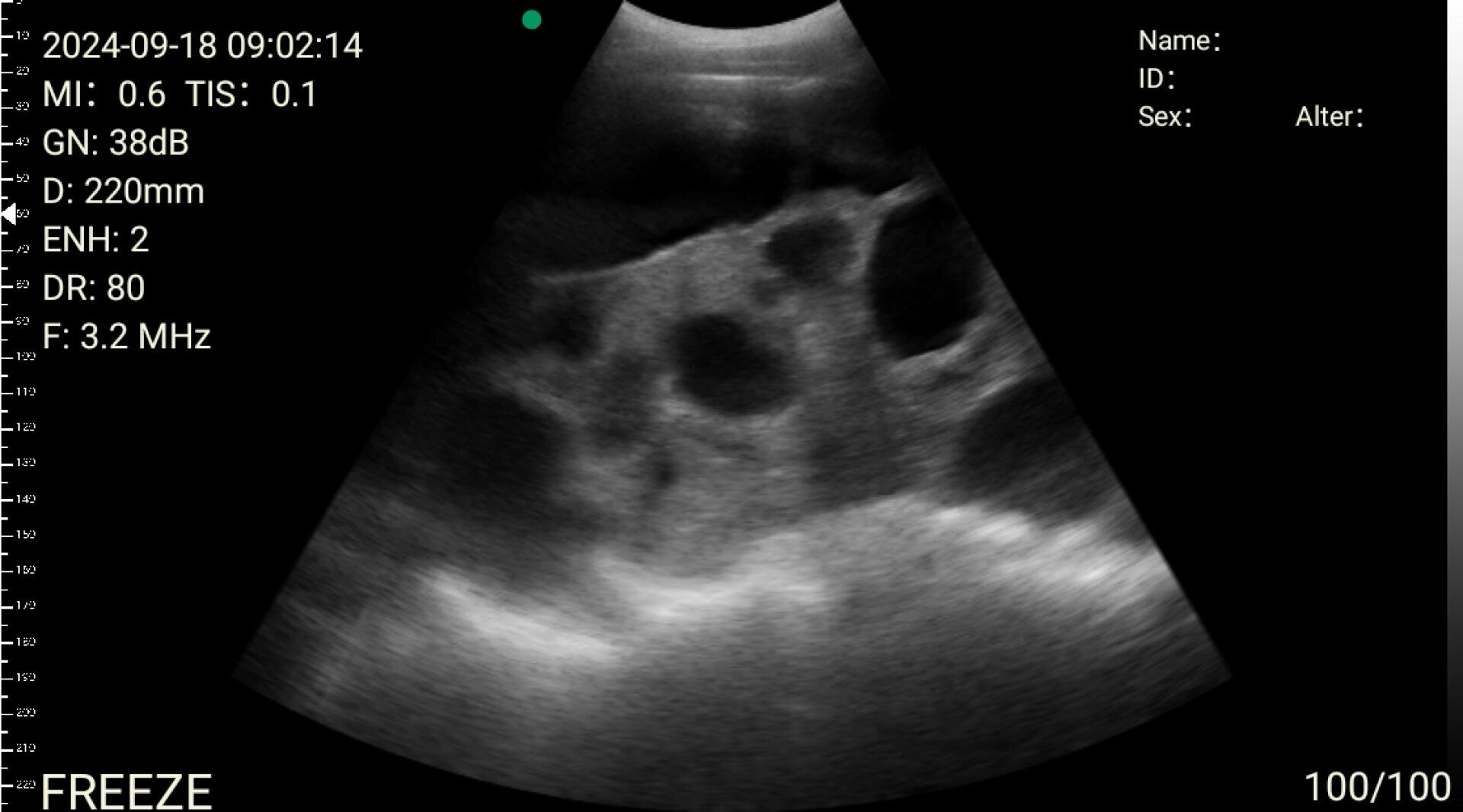 Ultraschallbild mit mehreren dunklen, runden zystischen Bereichen in einem Organ, möglicherweise einer Niere. Weiße Texteinblendungen zeigen Patienten- und Bilddetails auf der linken und rechten Seite des Bildes.